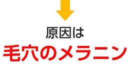 原因は毛穴のメラニン